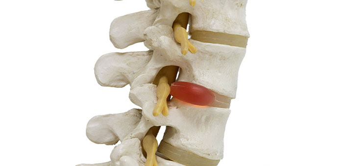 Herniated disc in spine before visiting Buckeye chiropractor