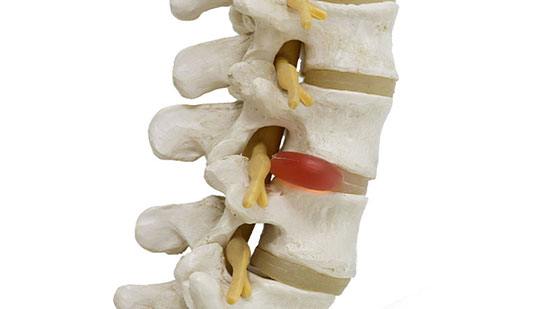 Herniated disc in spine before visiting Buckeye chiropractor