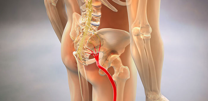 Sciatic nerve pain before chiropractic treatment from Buckeye chiropractor