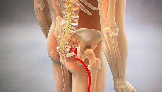 Sciatic nerve pain before chiropractic treatment from Buckeye chiropractor