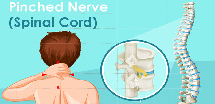 Pinched nerve in spine before chiropractic treatment from Goodyear chiropractor