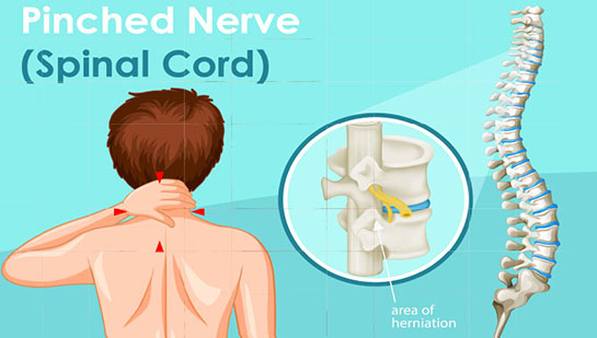 Pinched nerve in spine before chiropractic treatment from Goodyear chiropractor